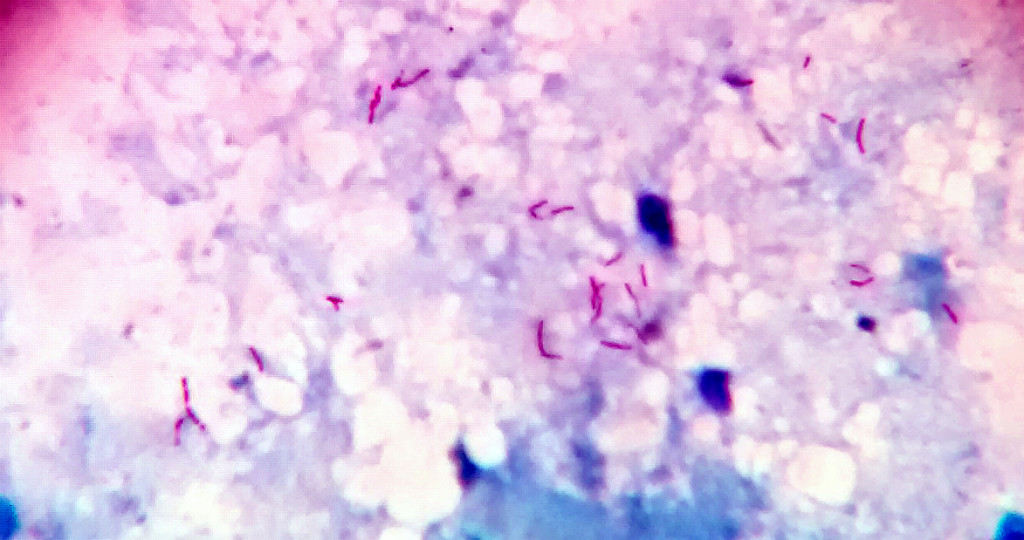 Bacilos mycobacterium tuberculosis en frotis de esputo